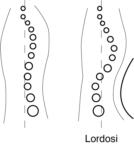 Lordosi